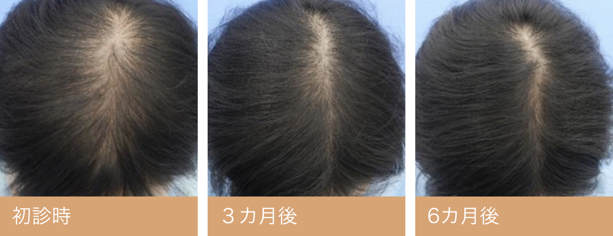 20代女性頭頂部・分け目薄毛写真・ビフォーアフター｜初診時　3カ月後　6カ月後
