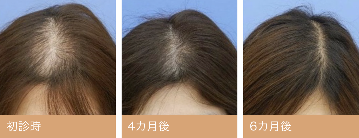 40代女性頭頂部・分け目薄毛写真・ビフォーアフター｜初診時　4カ月後　6カ月後
