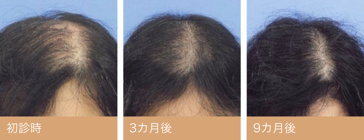 50代女性頭頂部・分け目薄毛写真・ビフォーアフター｜初診時　3カ月後　9カ月後