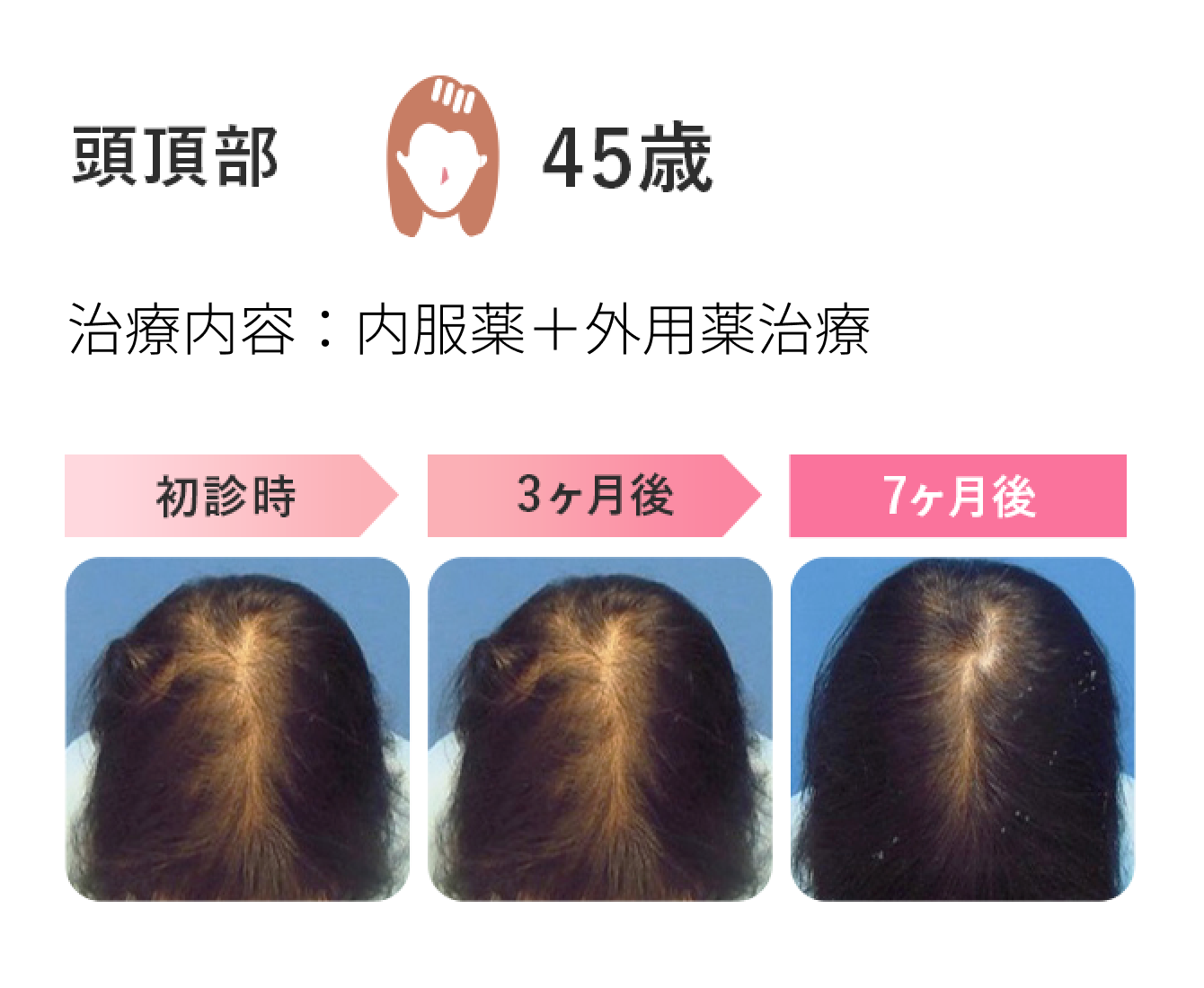頭頂部　45歳　治療内容：内服薬＋外用薬治療