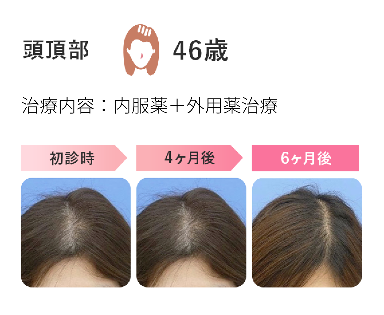 頭頂部　46歳　治療内容：内服薬＋外用薬治療