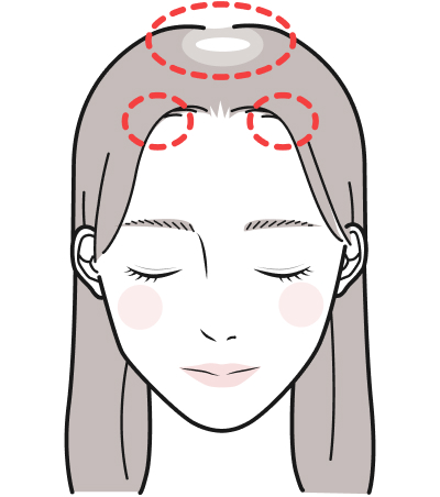 FAGA(女性男性型脱毛症)
